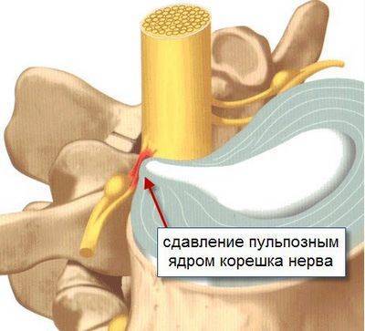 При остеохондрозе тахикардия