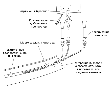 Катетер фолея медицинский