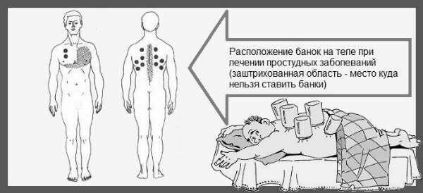 Можно при бронхите ставить банки или горчичники