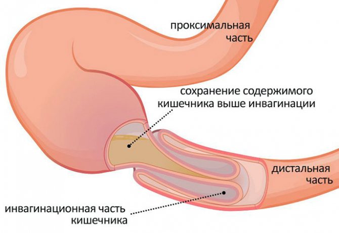 Заворот кишок