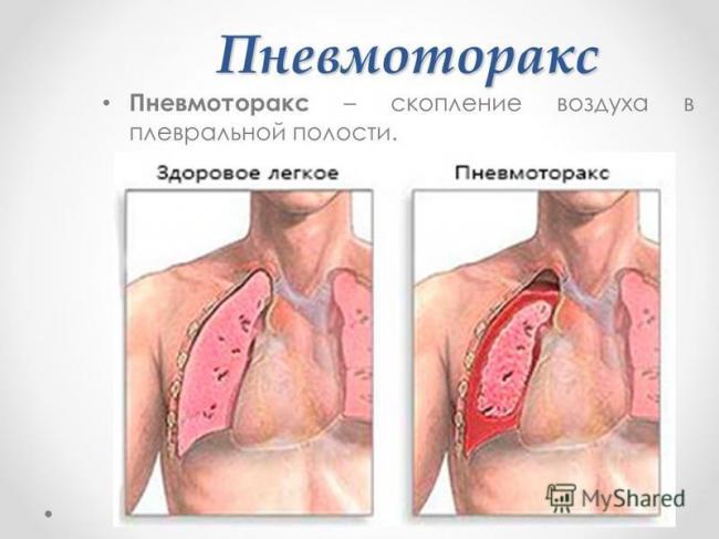 Грудная клетка неправильной формы