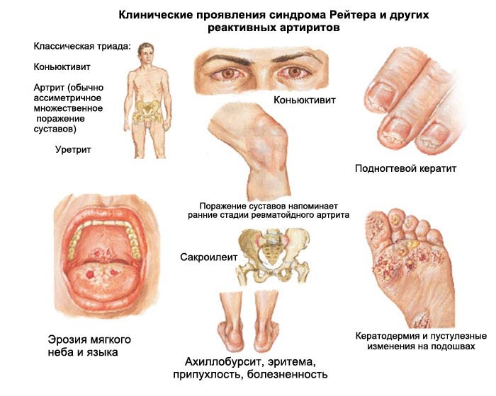 Серопозитивный ревматоидный артрит: что такое, симптомы и лечение