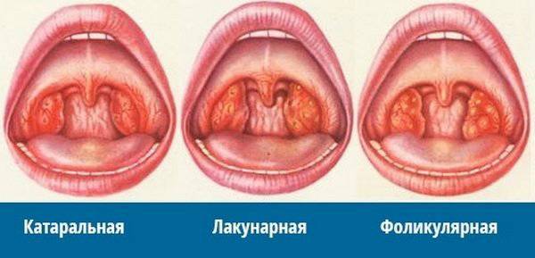Паратонзиллярный абсцесс - симптомы, лечение, вскрытие, диагностика