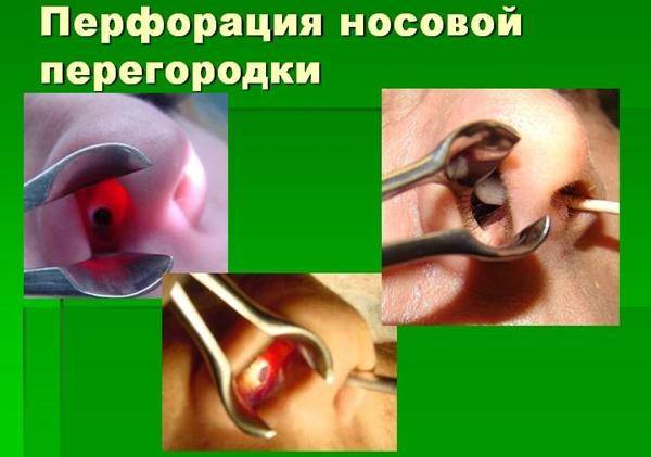 Искривление перегородки носа: причины, последствия, операция