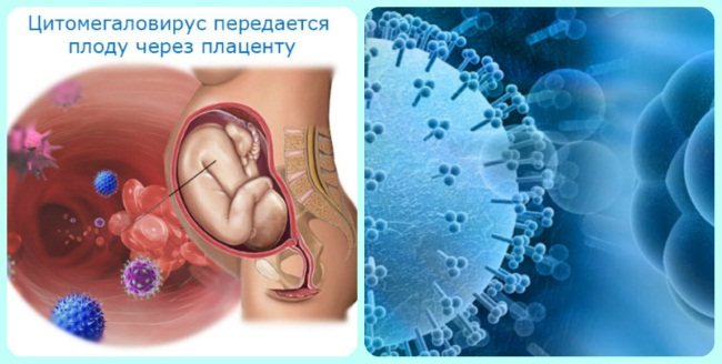 Цитомегаловирус – что это такое, как передается? цитомегаловирус – симптомы, лечение. цитомегаловирусная инфекция при беременности
