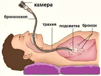 Ринит фарингит ларингит бронхит трахеит