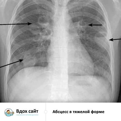 Гнойное воспаление легких у взрослых и детей