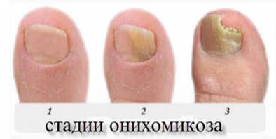 Онихомикоз (грибок ногтей). причины, симптомы, признаки, диагностика и лечение патологии