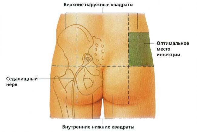 Рекомендации врачей, как правильно колоть диклофенак