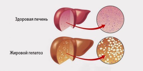 Диета при жировом гепатозе