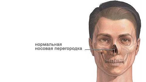 Септопластика