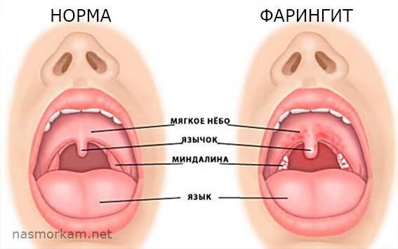 Боль в горле слева при глотании