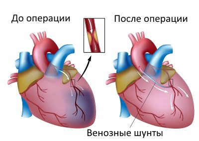Шунтирование или стентирование? что эффективней и безопаснее?