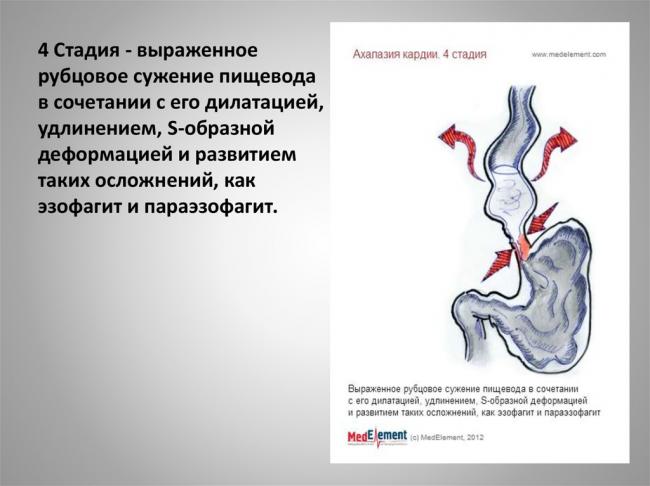 Что собой представляет ахалазия кардии (кардиоспазм)