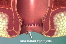 Что такое анальная трещина