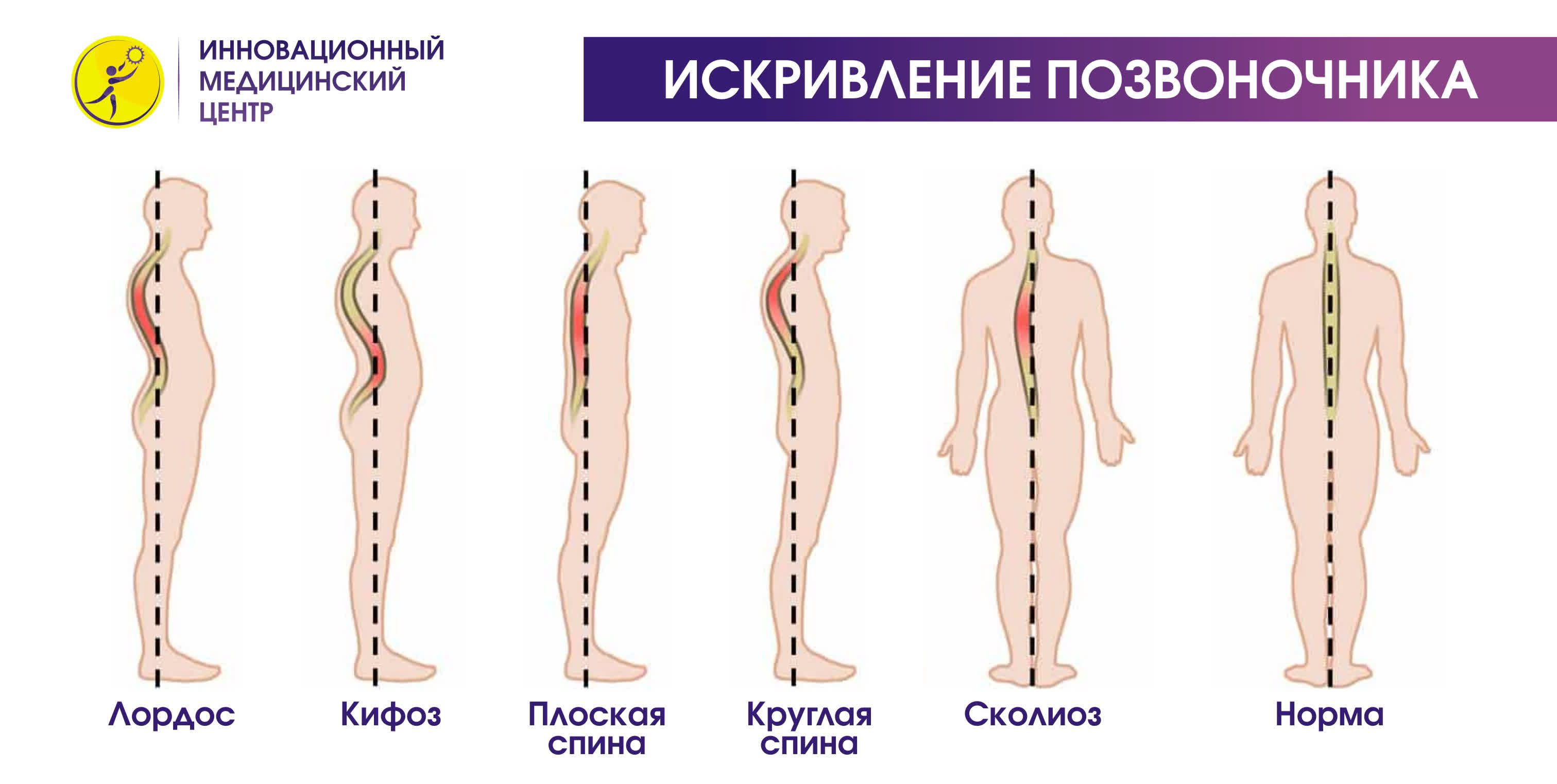 Сколиоз 1 степени: лечение (домашних условиях), фото