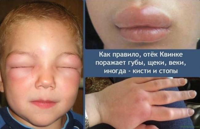 Аскофен Ультра Ascophen Ultra