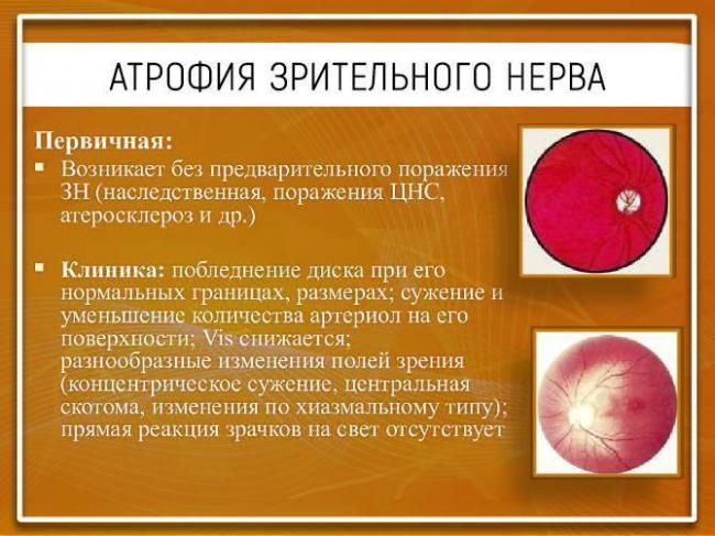 Лечение атрофии зрительного нерва народными средствами