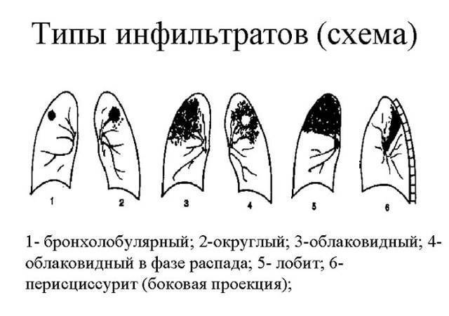 Почему развивается очаговый туберкулез легких?