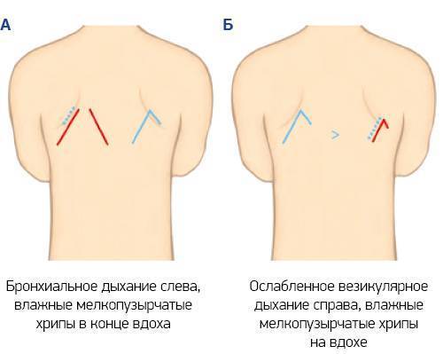 Сколько держаться хрипы при бронхите