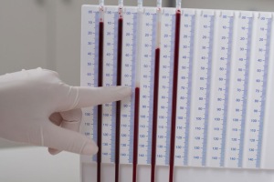 Повышенное соэ в крови: что это значит, причины и симптомы высокого значения соэ, что делать