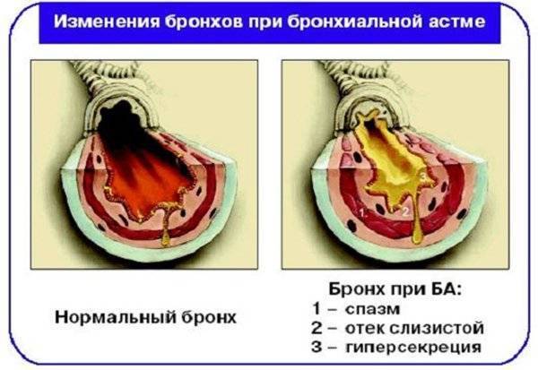 Можно ли умереть от бронхиальной астмы: причины смерти и меры предосторожности