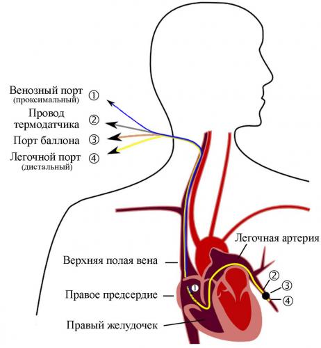 Катетер: разновидности, установка, уход | food and health