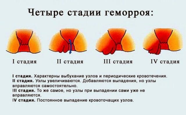 Эффективные ректальные свечи при запорах