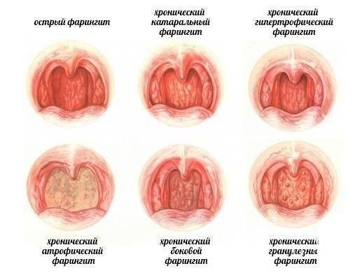 Режущая боль в горле с одной стороны - причины и лечение