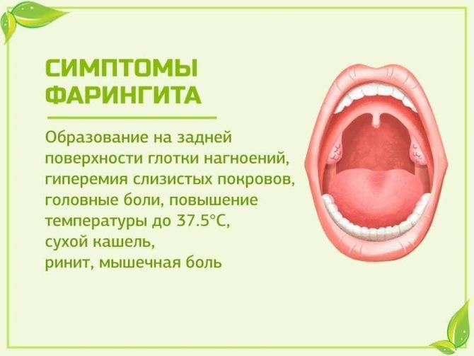 Фарингит: хронический, острый, причины, признаки, как лечить