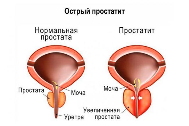 Симптомы основных заболеваний предстательной железы
