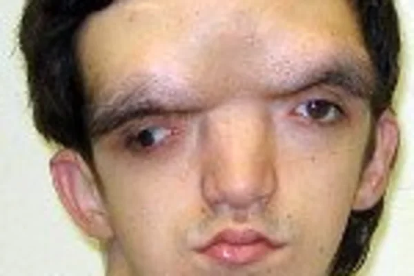 Невралгия тройничного нерва: симптомы и лечение