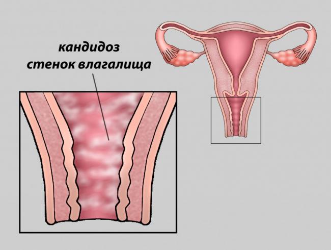 Желтые выделения без запаха у женщин — причины и методы лечения