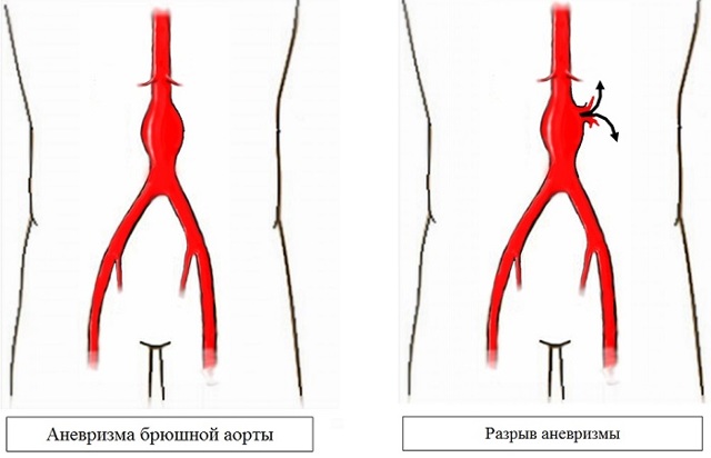 Аневризма аорты. причины и симптомы