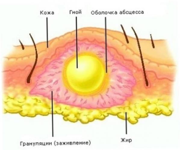 Бартолинит. абсцесс и киста бартолиновой железы