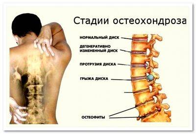 Грыжа диска с5 с6 шейного отдела позвоночника при остеохондрозе