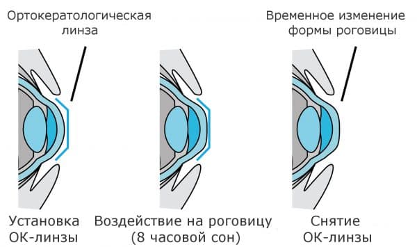 Контактные линзы ночные линзы paragon 100 - отзывы