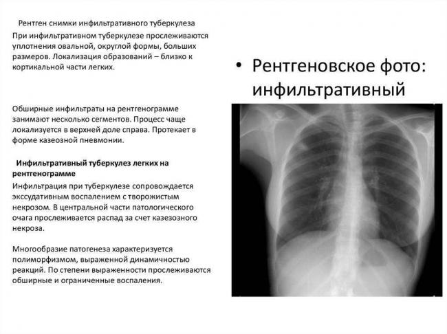 Пневмония при туберкулезе легких: особенности проявления, лечение и прогноз