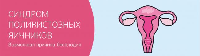 Поликистоз яичников (спкя): симптомы, причины, лечение