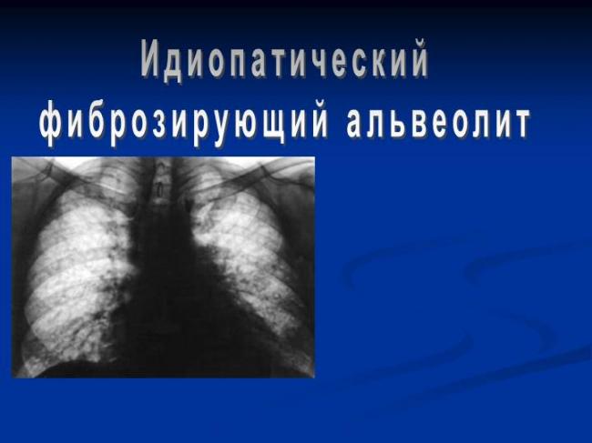 Альвеолит - симптомы, лечение, осложнения, альвеолит легких