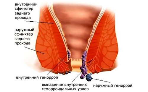 Геморрой и рак: как отличить на ранних стадиях патологии?