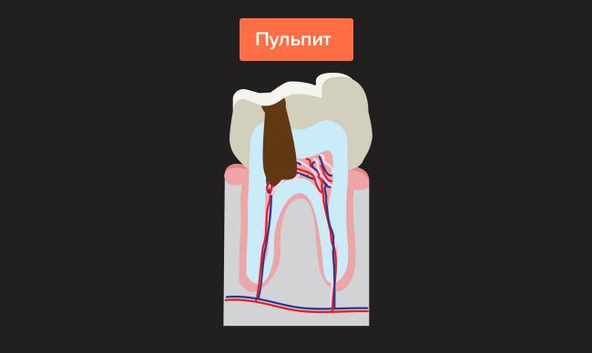 Пульпит зуба – причины и современное лечение
