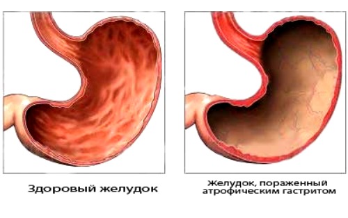 Недостаточность кардиального жома