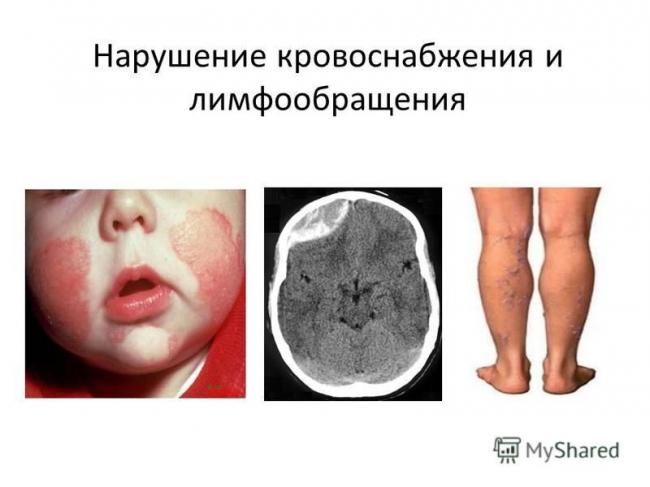 Нарушение кровообращения — симптомы, лечение, причины — симптомы