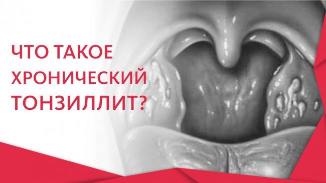 Воспаление глоточной миндалины у взрослых симптомы. принципы лечения бактериальной инфекции. что нужно делать во время воспаления гланд