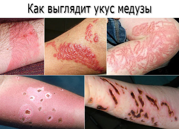 Что делать при ожоге медузы на отдыхе на море?