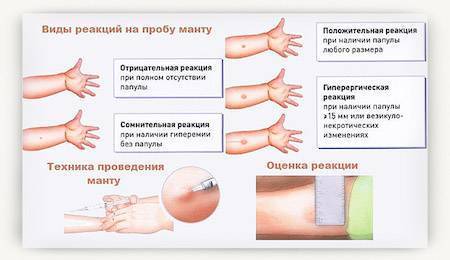 Как выглядит аллергия на манту у ребенка?