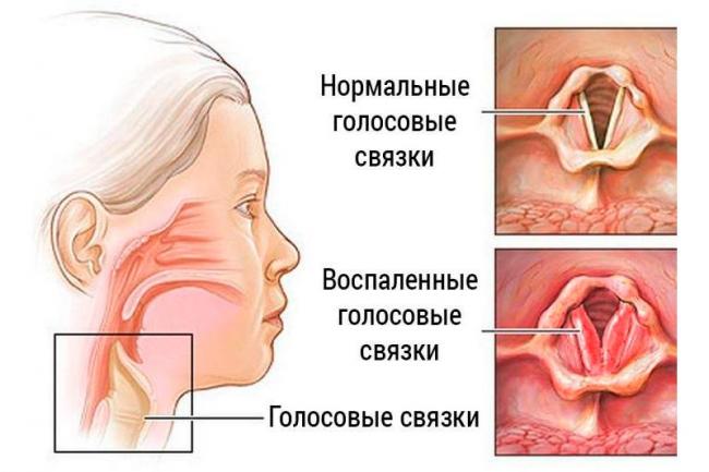 Ларингит (острый) - симптомы болезни, профилактика и лечение ларингита (острого), причины заболевания и его диагностика на eurolab