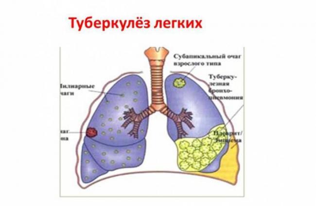 Признаки туберкулеза на ранних стадиях у взрослого – риск заражения