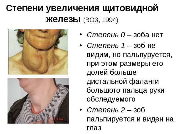 Диффузный зоб – патология щитовидной железы